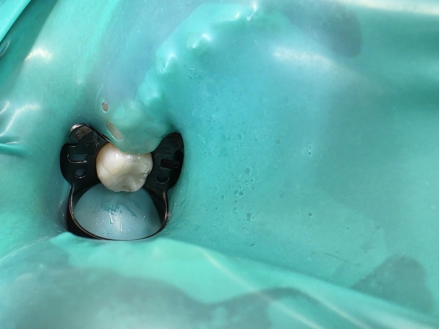 ●セラミック修復物のレジンセメントによる合着の際、ラバーダム防湿の重要性