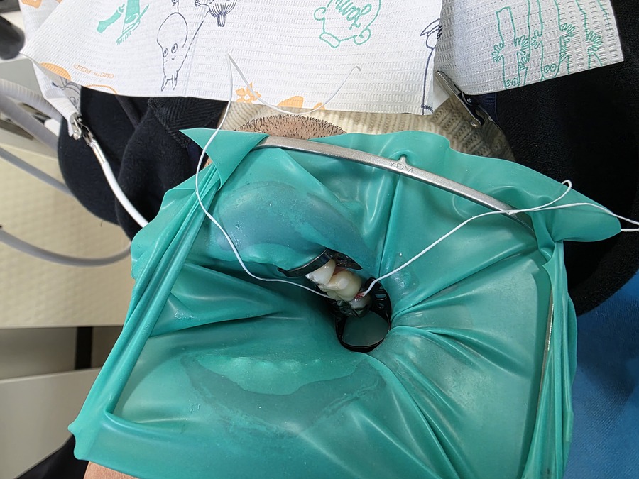 ●補綴専門医がラバーダム防湿を重視する理由