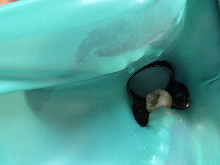 ●補綴専門医がラバーダム防湿を重視する理由